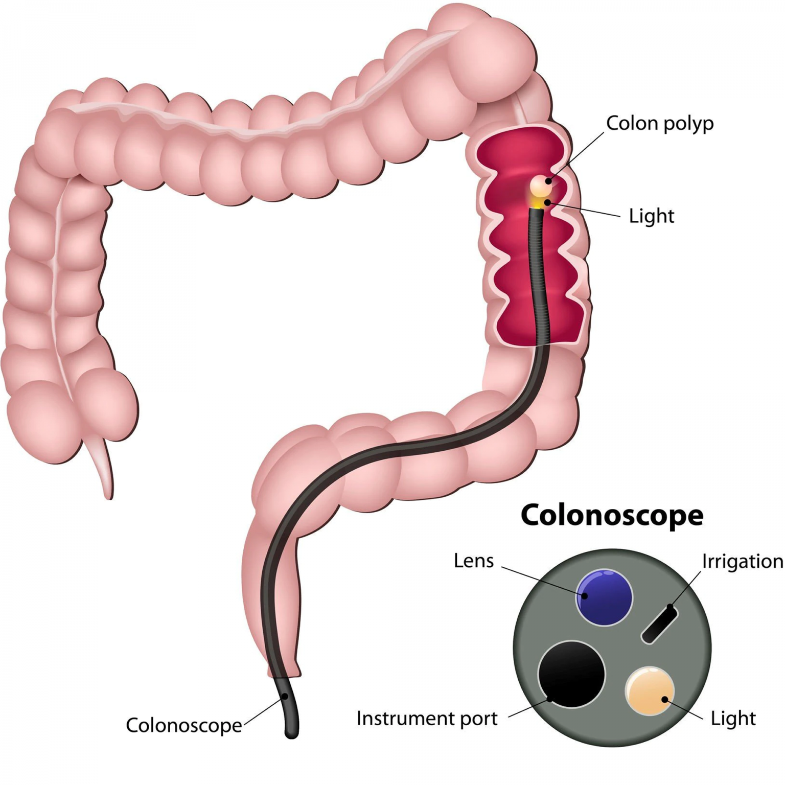 the-best-colonoscopy-prep-tips-according-to-doctors-anti-nausea