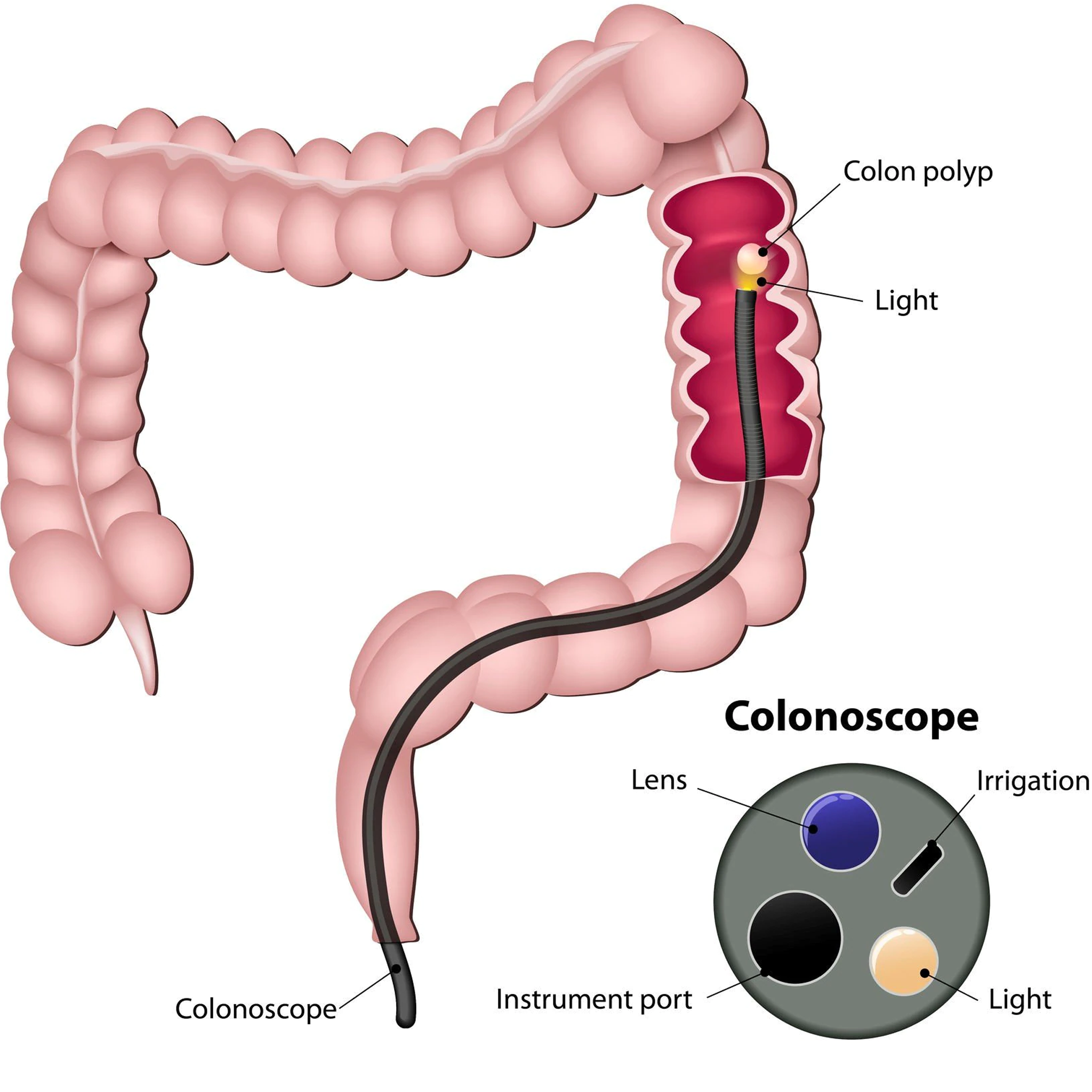 crohn's home test